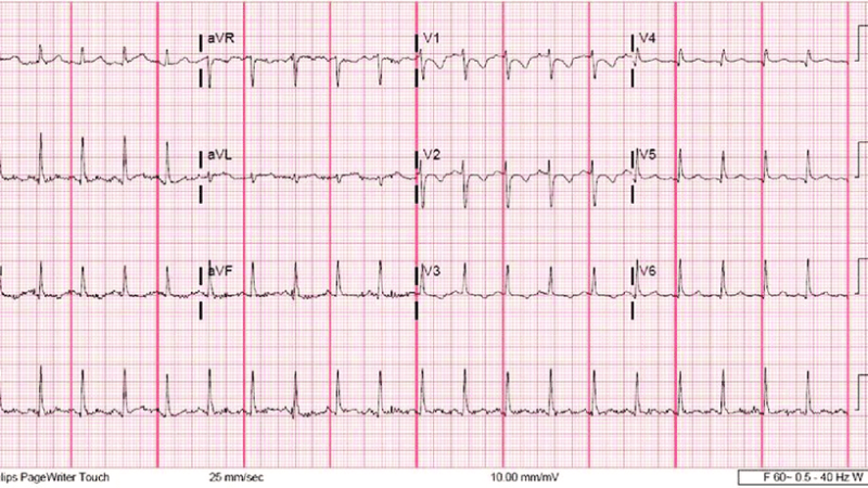 Borderline ecg