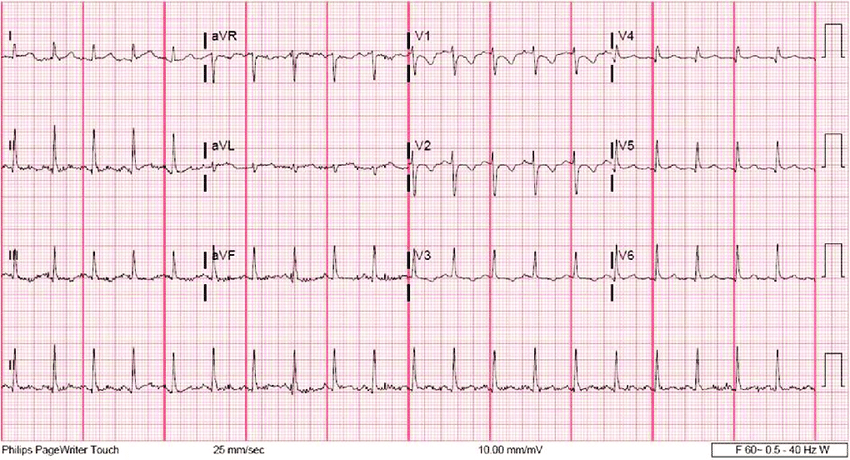 Borderline ecg