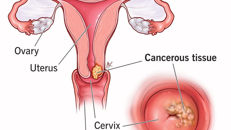 Cervical Cancer